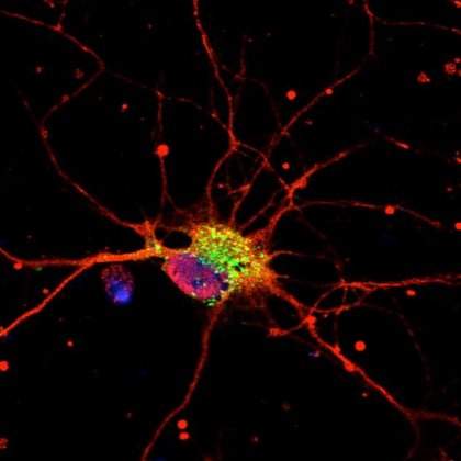 Neurodegeneration in action. The mutated Munc18-1 proteins (green in this image) trigger the clumping of α-Synuclein (large red blobs). 